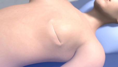 Going Flat After Mastectomy: A Week-by-Week Recovery Timeline