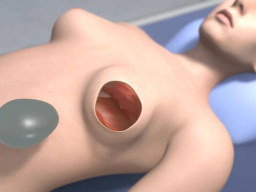 Tissue Expander Exchange: What to Expect from the Second Surgery