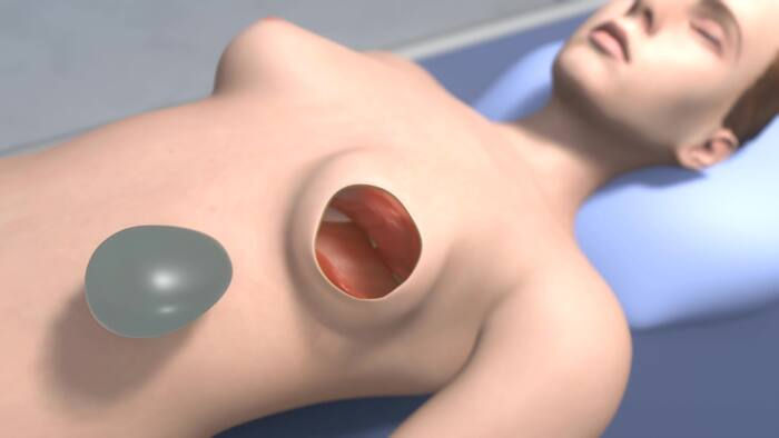 Tissue Expander Exchange: What to Expect from the Second Surgery