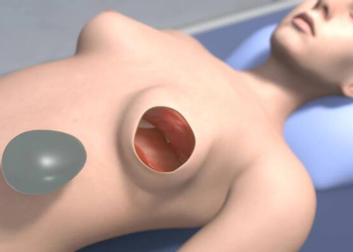 Illustration des Gewebeexpander-Wechsels.