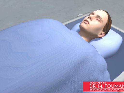 شريحة LICAP: إصلاح عيوب الثدي بعد استئصال الورم في الأورام العلوية والجانبية