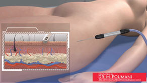 Bild aus der Operationsanimation zum Lipofilling der Brust.