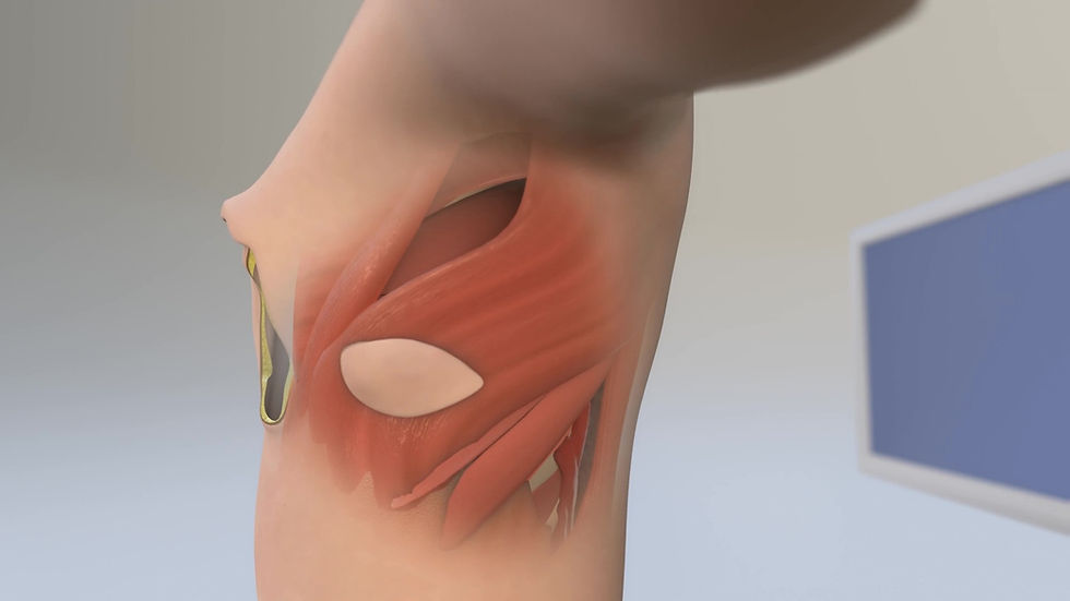Latissimus Dorsi (LD) Flap Borstreconstructie: Een Betrouwbare Methode met Rugweefsel