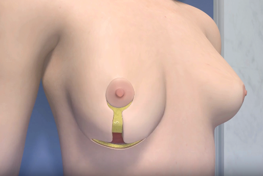 Breast Symmetry Surgery After Lumpectomy, Mastectomy, or Reconstruction: Balancing the Unaffected Breast