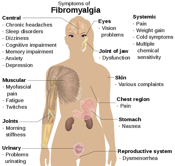 Fibromyalgia