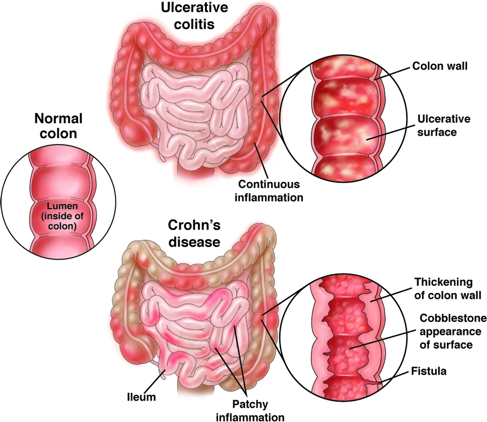 IBD
