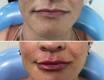 Preenchimento Labial