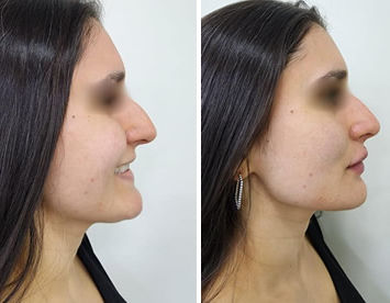 Rinomodelação com Preenchimento Labial