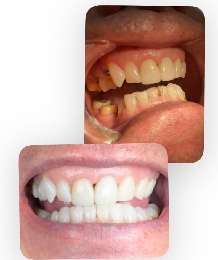 ჩარლის პირის ღრუს მდგომარეობა მკურნალობამდე და მკურნალობის შემდეგ ულტრადენტი თბილისი სტომატოლოგიური კლინიკა