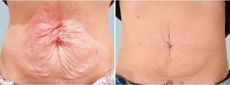 This client reported feeling a boost in confidence after using HIFU on her abdomen, noting a visible difference comparable to results seen from invasive surgeries known as a tummy tuck.