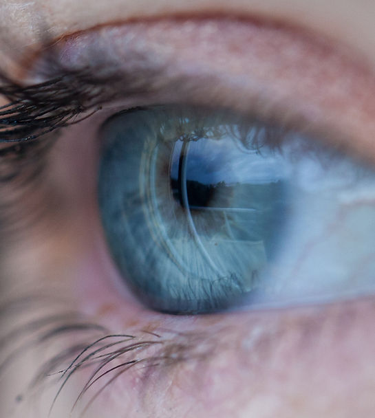 Cornea Transplant