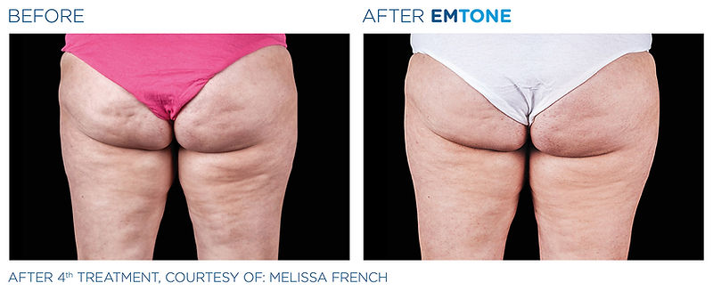 Emtone_PIC_Ba-card-female-buttock-003_EN100.jpg