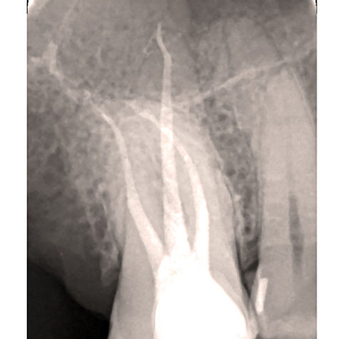 ROOT CANAL TREATMENT.jpg