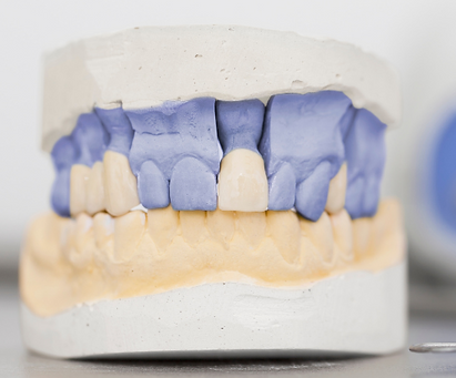 Modello 3D protesi dentale su impianti - studio dentistico GLP