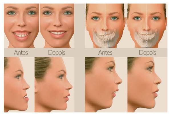 Sinais de que você precisa fazer uma Cirurgia Ortognática