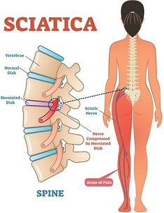 Sciatica Anatomy