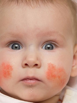 Chàm sữa ở trẻ sơ sinh