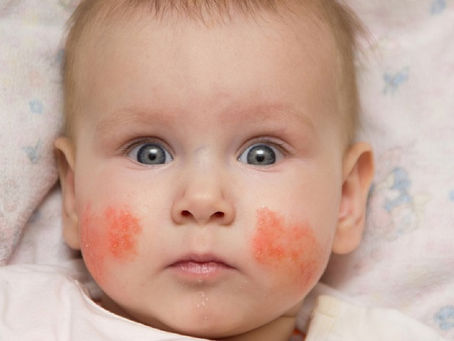 Chàm sữa ở trẻ sơ sinh