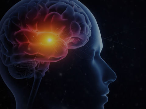 An image of a brain during an ischemic stroke