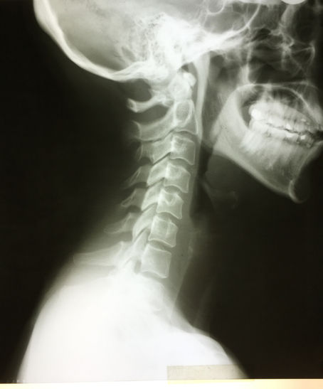 Upper Cervical Instability Following Head Trauma