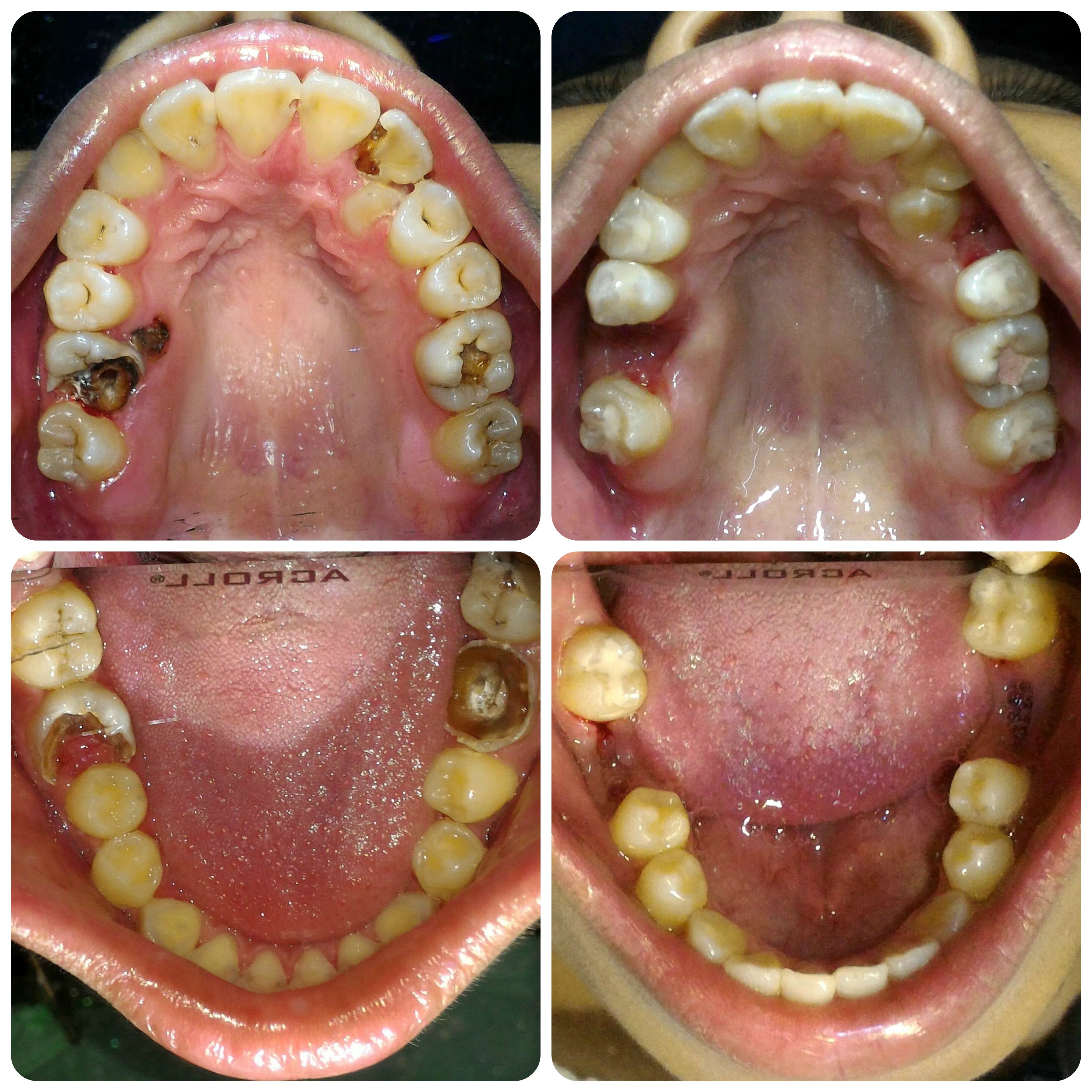 tooth fillings