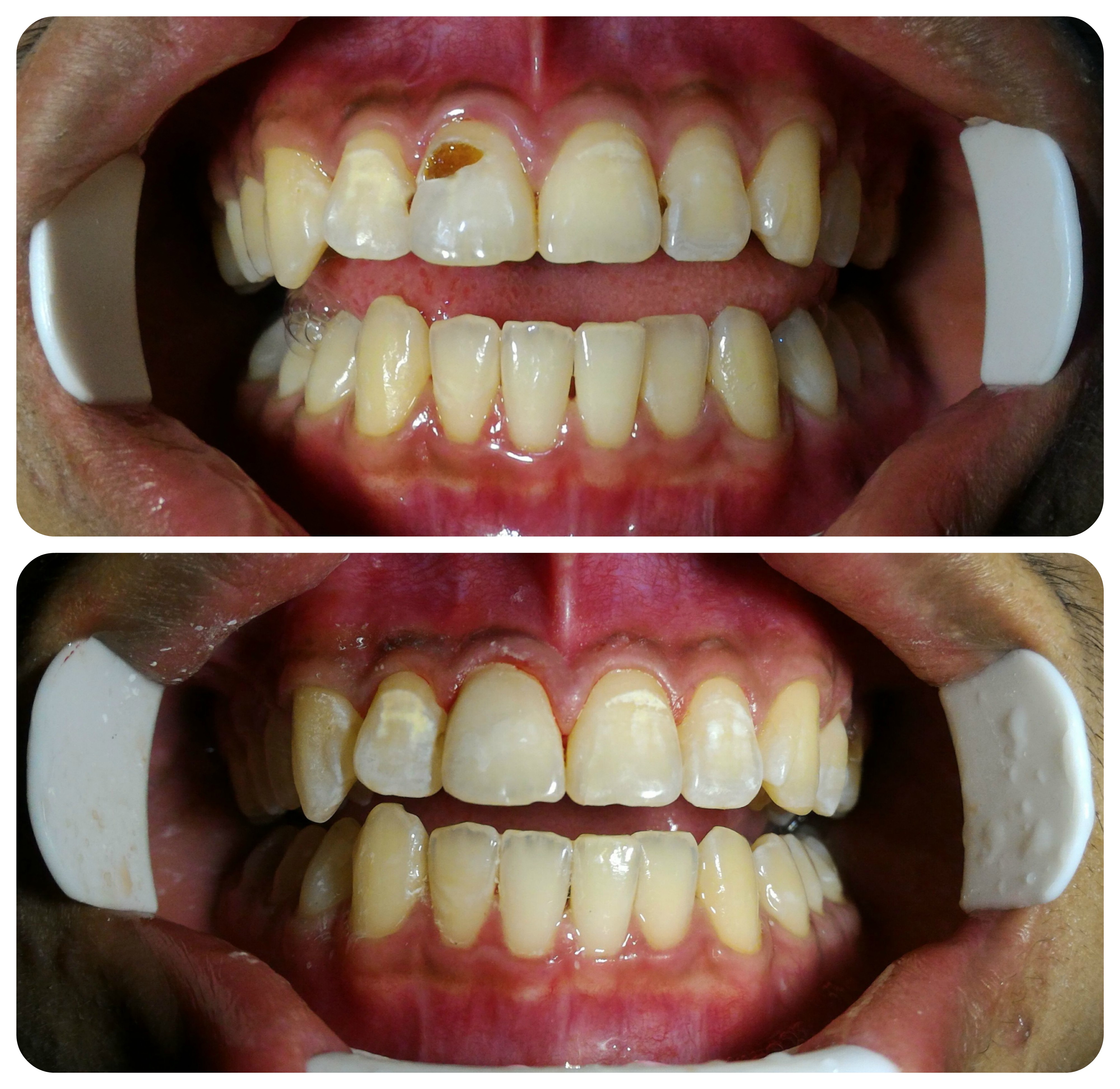tooth fillings