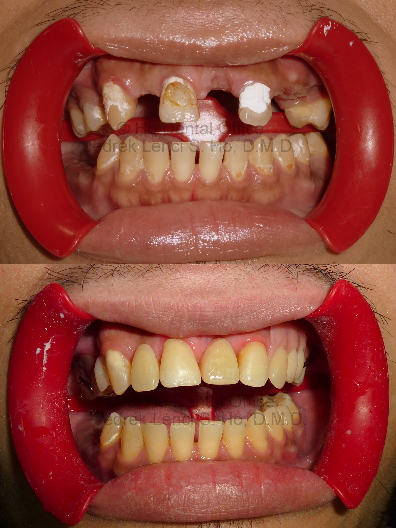 aesthetic tooth restoration + dentures