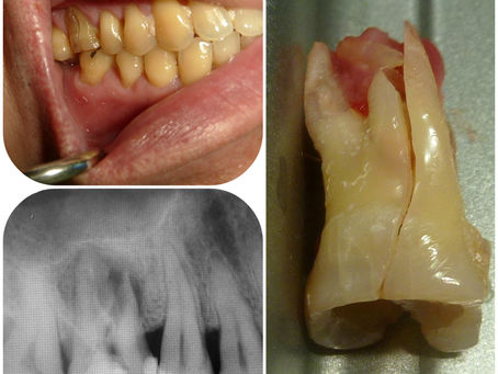 vertical tooth fractures = goodbye!