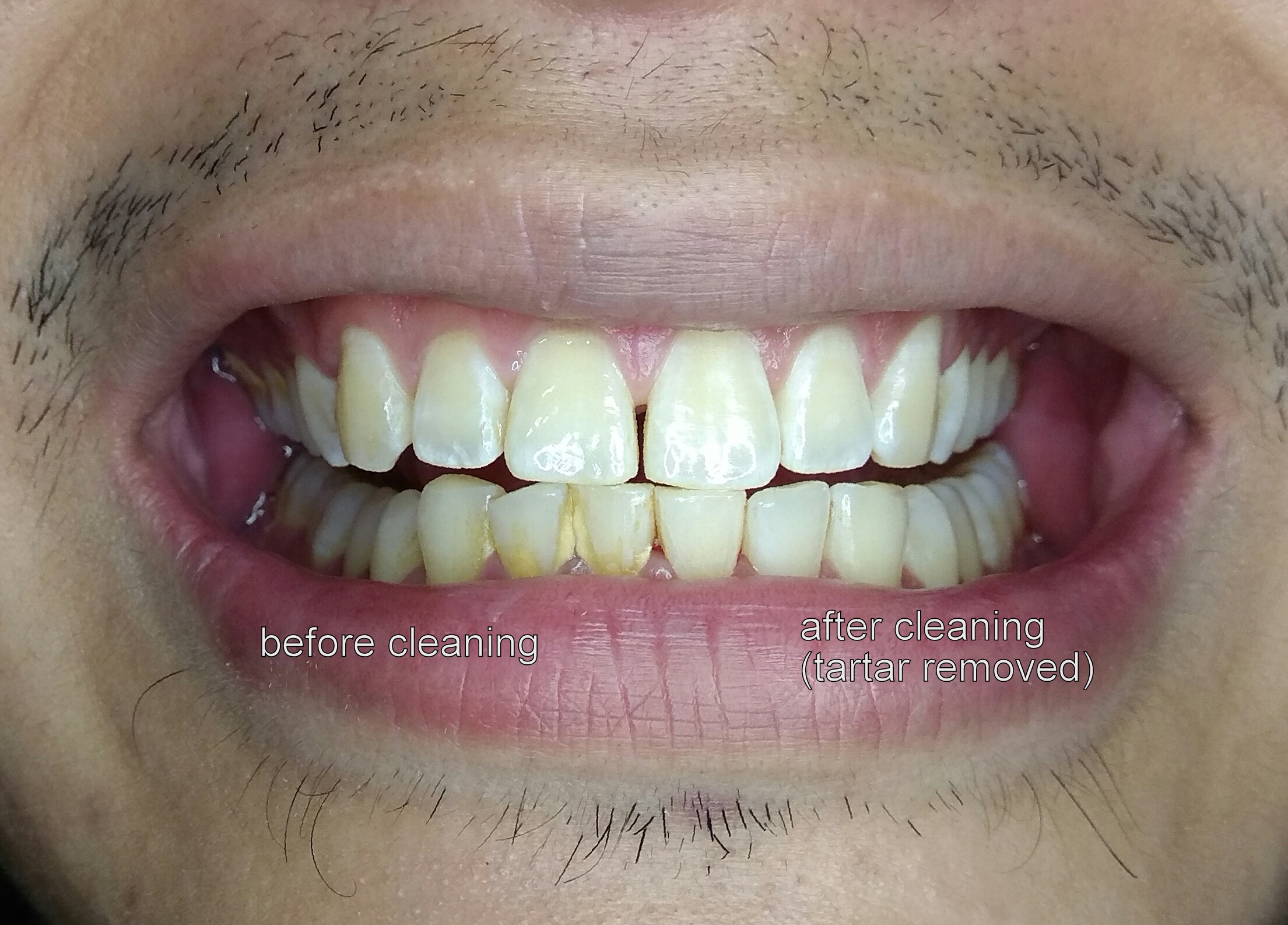 oral prophylaxis - before and after