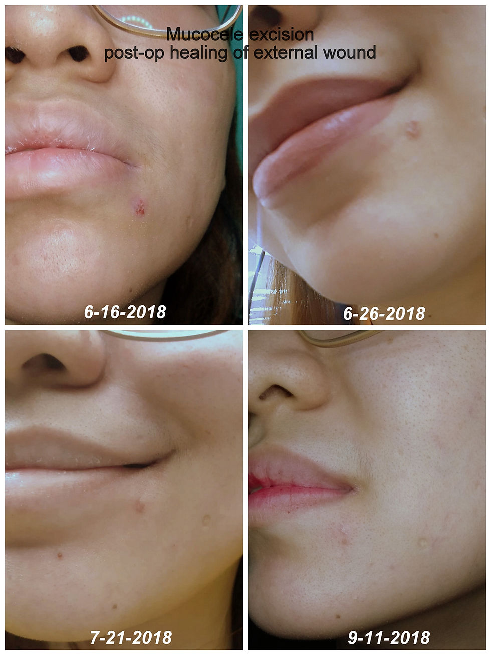 mucocele excision external wound healing 3 months follow up