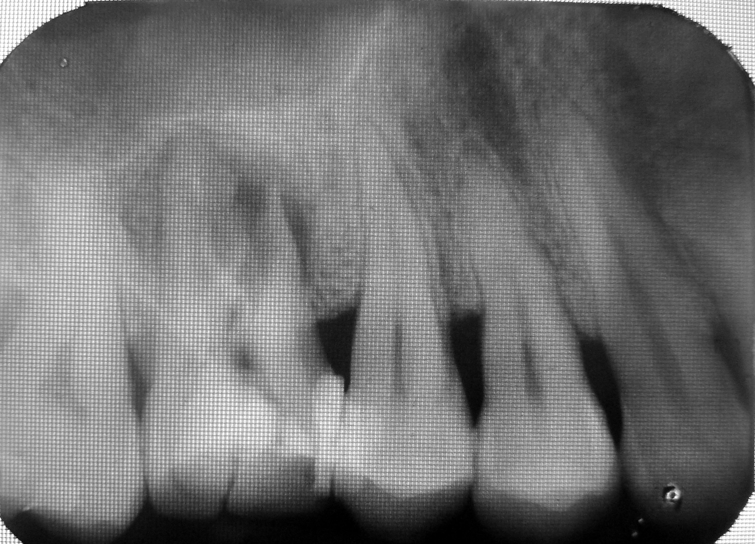 x-ray radiography showing fracture