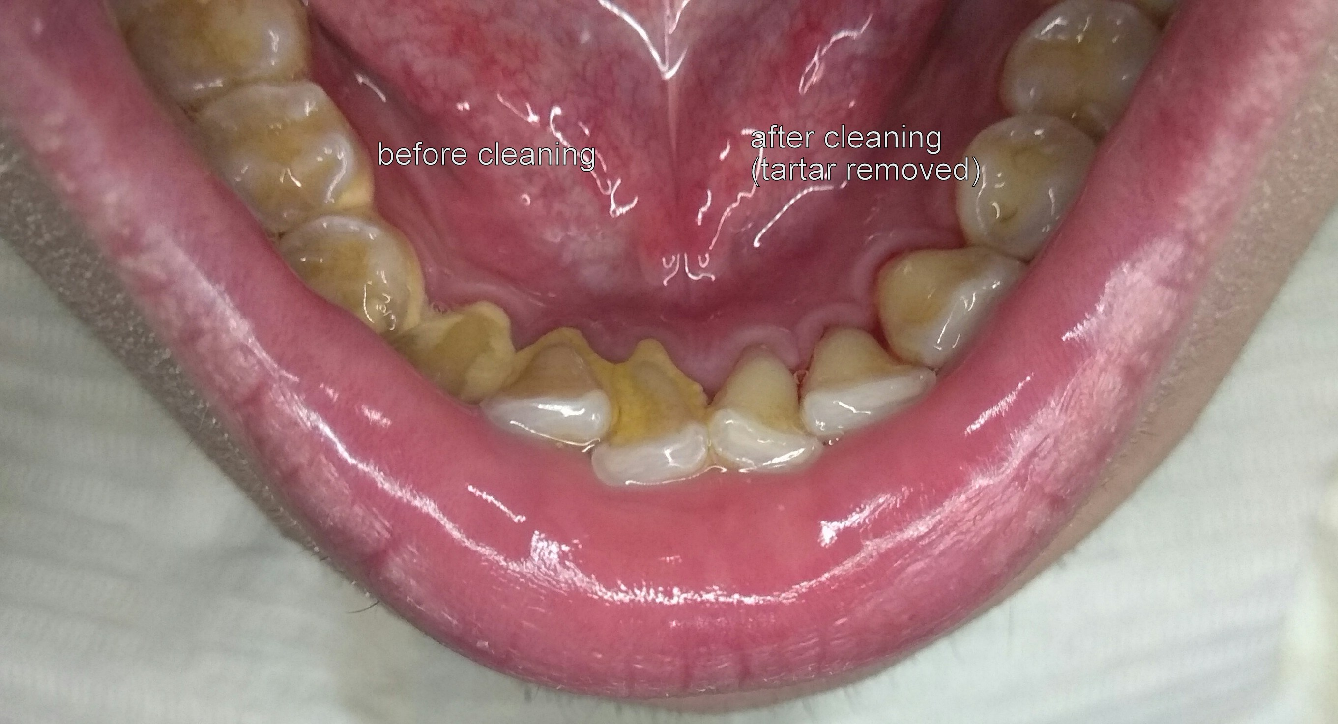 oral prophylaxis - before and after