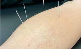 dry needling.jpg