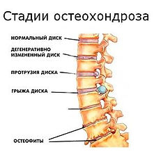 stadii_osteohondroza.jpg