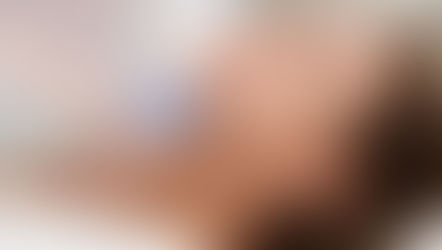 Como Melhorar o Resultado da Radiofrequência na Pele — Flacidez e Rejuvenescimento