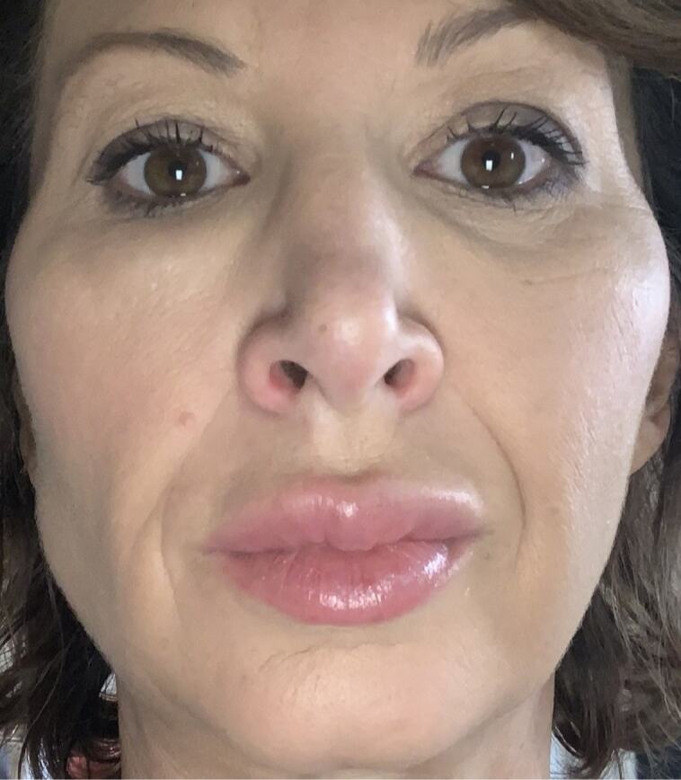 A verdade sobre o preenchimento facial com ácido hialurônico e seus riscos