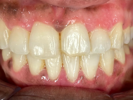 Natuurlijk herstel met composiet – minimaal invasief en esthetisch