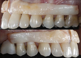 enxerto gengival 12 elementos