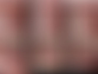 A modified tunnel technique to treat multiple gingival recessions: Case Series