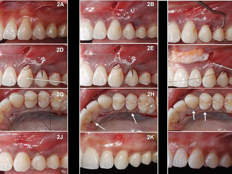 A modified tunnel technique to treat multiple gingival recessions: Case Series