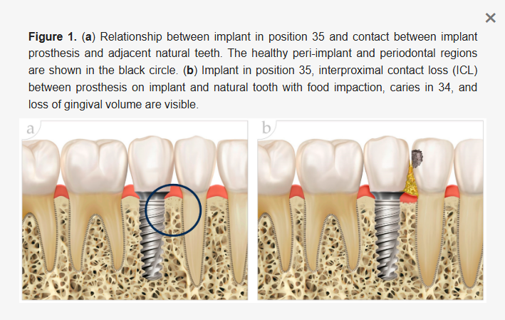 Contatos interproximais e sua relevância na estética gengival e reabilitações sobre implantes