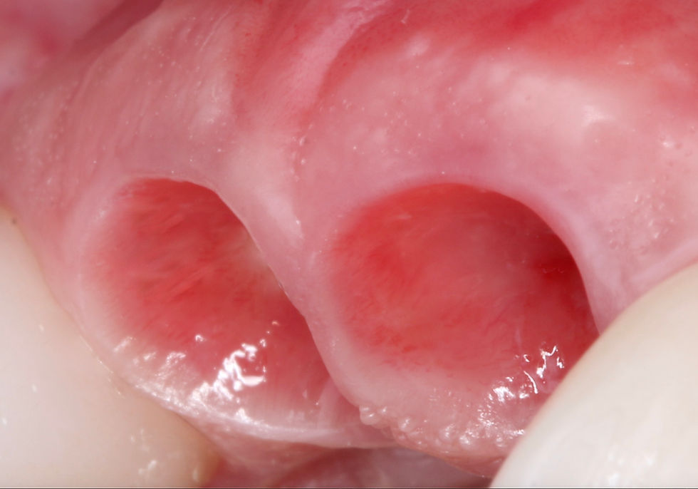 Perfil de emergência côncavo, moldando tecidos para uma estética natural.