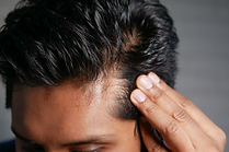 Receding temples leading to hair loss and baldness
