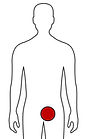Leistenbruch Bauchwandbruch Nabelbruch Hernienchirurgie Köln Düsseldorf Haan Hilden