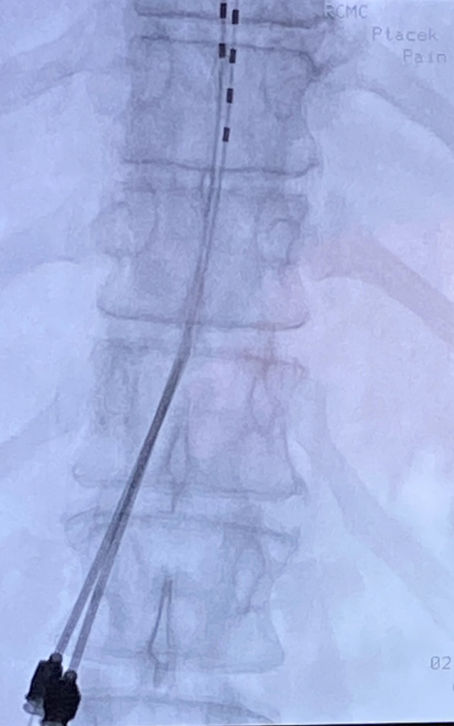 Unlocking Relief: The Unknown Power of Spinal Cord Stimulation for Chronic Pain