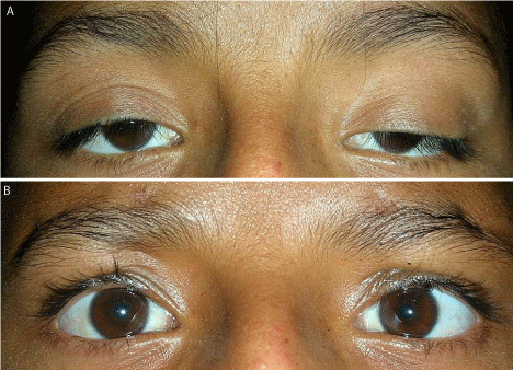 Ptosis