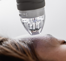 a women getting microneedling of forehead