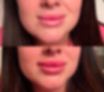 Lip filler