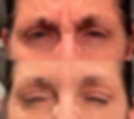 Neurotoxin Treatment