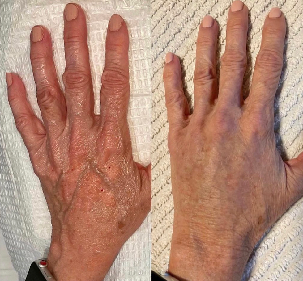 Hand Filler